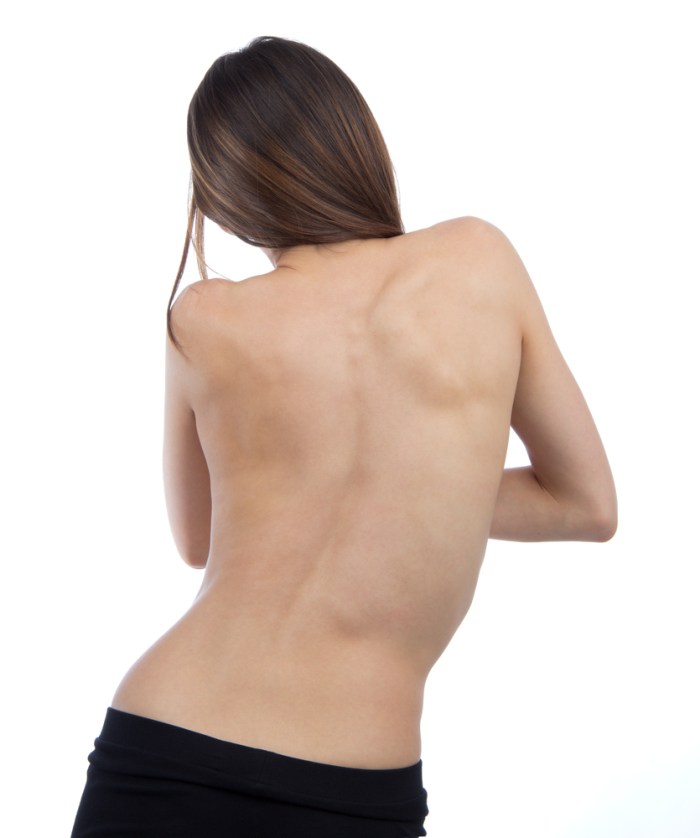 scoliosis1
