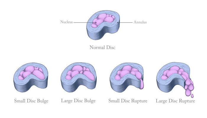 Ruptured-disc-diagram-final_800x